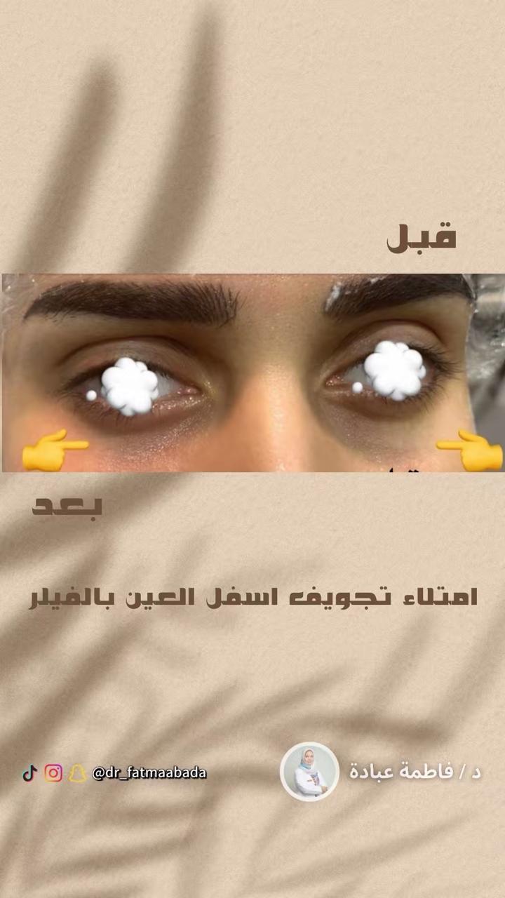 فيلر