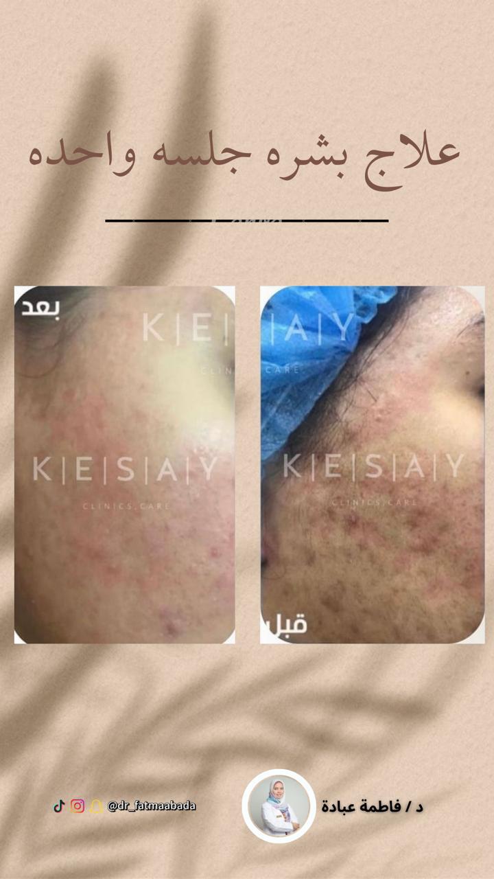 علاج البشرة